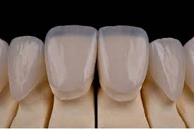 Successful ceramic veneers