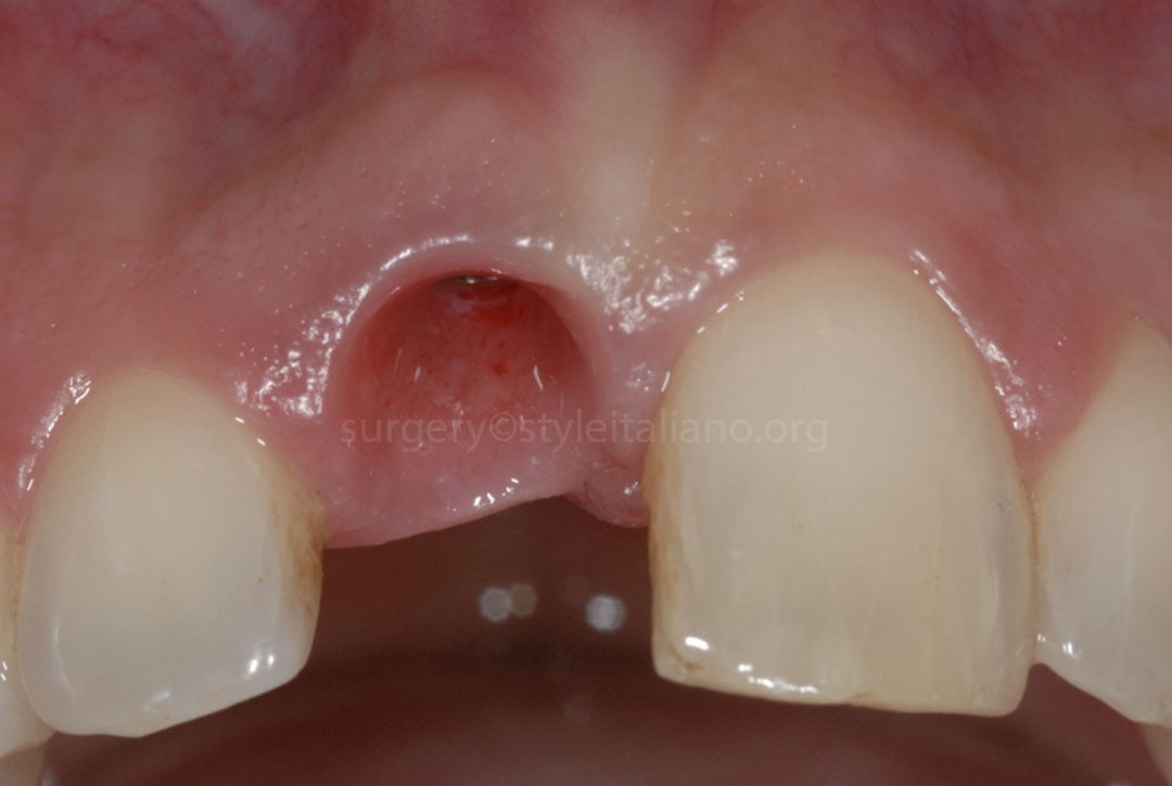 Les implants post-extraction immédiats et le chargement immédiat.  Gestion des tissus mous autour des implants