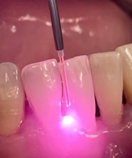 Applications Cliniques des Lasers en Odontologie