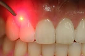 Applications Cliniques des Lasers en Odontologie