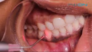 Applications Cliniques des Lasers en Odontologie