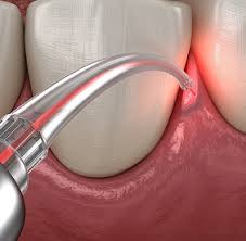 Applications Avancées du Laser en Parodontologie, Implantologie et Dentisterie Restauratrice