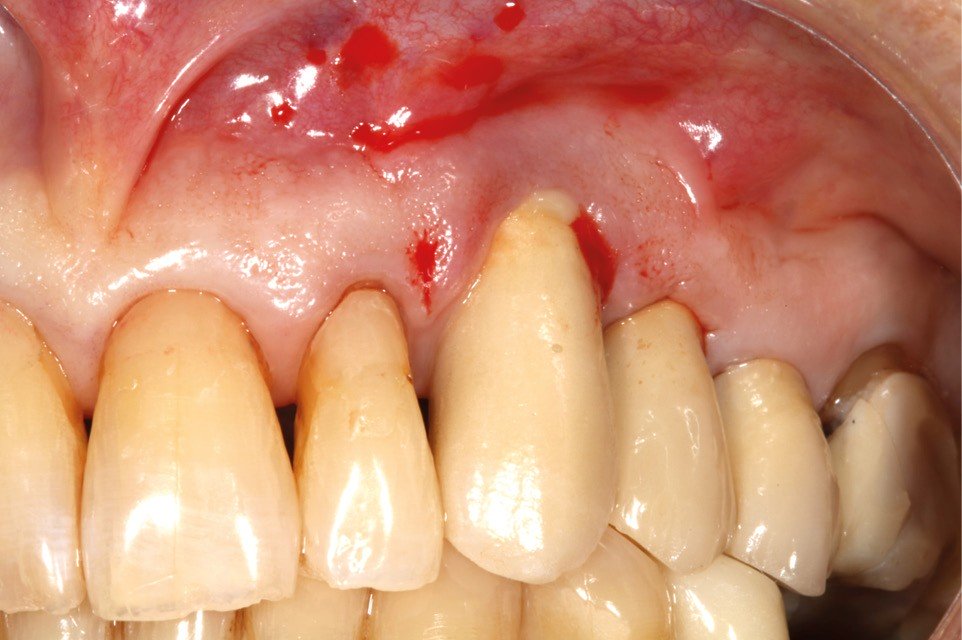 Applications Avancées du Laser en Parodontologie, Implantologie et Dentisterie Restauratrice