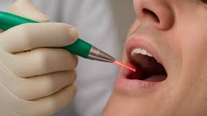 Applications Avancées du Laser en Parodontologie, Implantologie et Dentisterie Restauratrice