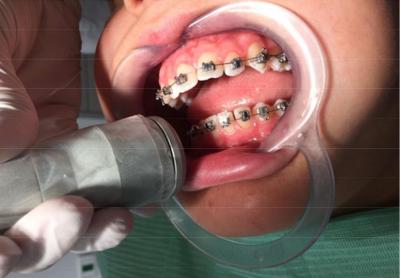 Thérapie Photobiomodulatoire (PBM) & Laser en Pratique Dentaire Quotidienne