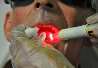 Thérapie Photobiomodulatoire (PBM) & Laser en Pratique Dentaire Quotidienne