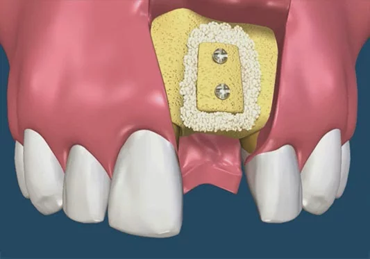 Technique régénérative — photo 3