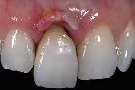 Les implants post-extraction immédiats et le chargement immédiat. Gestion des tissus mous autour des implants — photo 1