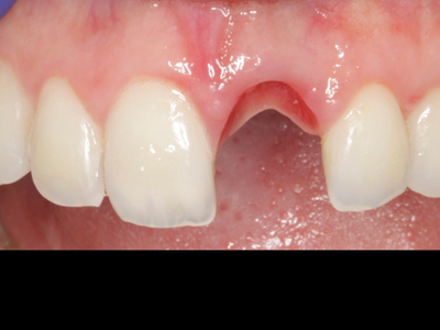 Les implants post-extraction immédiats et le chargement immédiat. Gestion des tissus mous autour des implants — photo 2