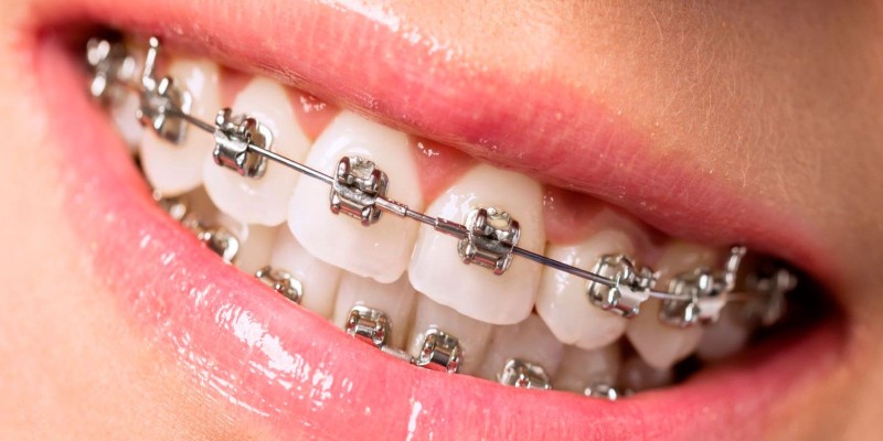 L'orthodontie basique & avancée
