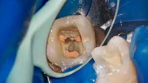 Full immersion in modern endodontics