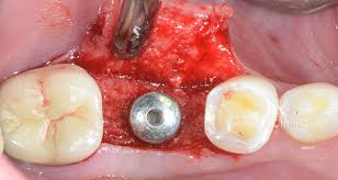 Chirurgie en Implantologie — image 2