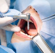 Chirurgie en Implantologie — image 3