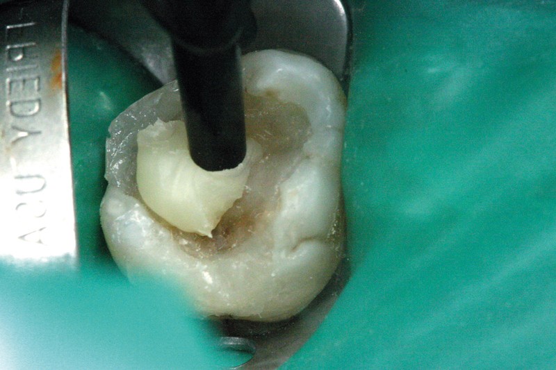 Restauration indirectes postérieure (THEORIE + WORKSHOP)
