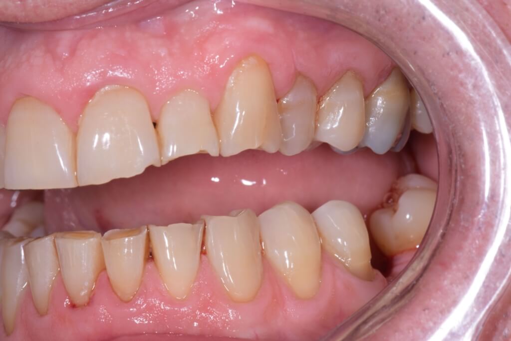 La parodontologie en esthétique (THEORIE)