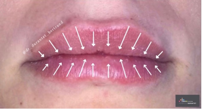 Intégration de la dentisterie esthétique et cosmétique du visage: Botox et produits de comblement dermique (THEORIE + WORKSHOP) + LASER DENTAIRE
