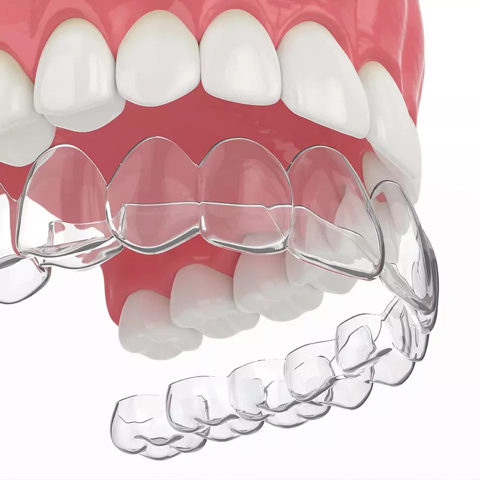 Aligners (design, staging, fabrication) — photo 1