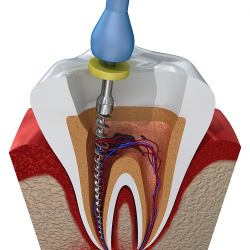 Les Fondamentaux de l’Endodontie Clinique : Accès, Mise en Forme et Obturation  (Théorie et pratique)