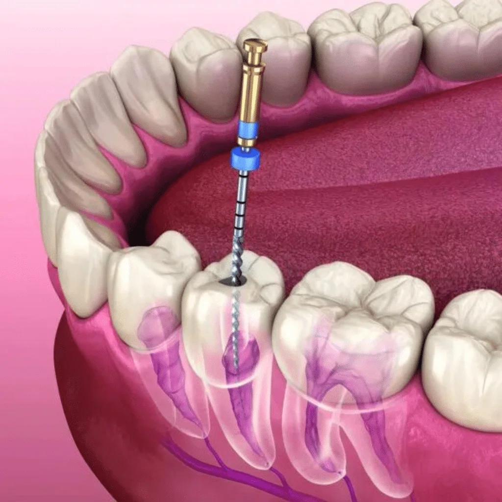 Retraitement Endodontique : Stratégies, Techniques et Gestion des Complications (Théorie et pratique)
