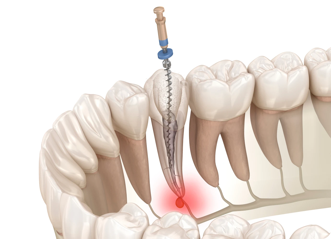 Retraitement Endodontique : Stratégies, Techniques et Gestion des Complications (Théorie et pratique)