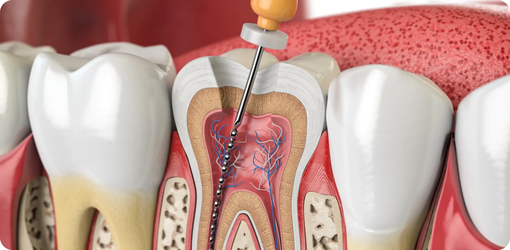 Retraitement Endodontique : Stratégies, Techniques et Gestion des Complications (Théorie et pratique)