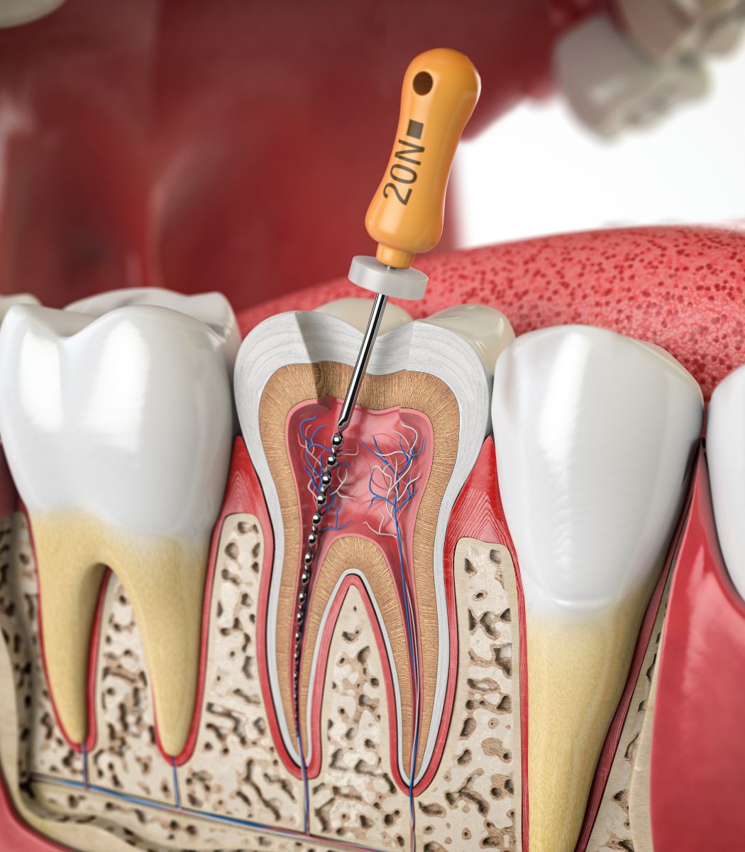 Urgences, Pathologies et Cas Complexes en Endodontie : Diagnostic, Traitement et Approches Avancées
