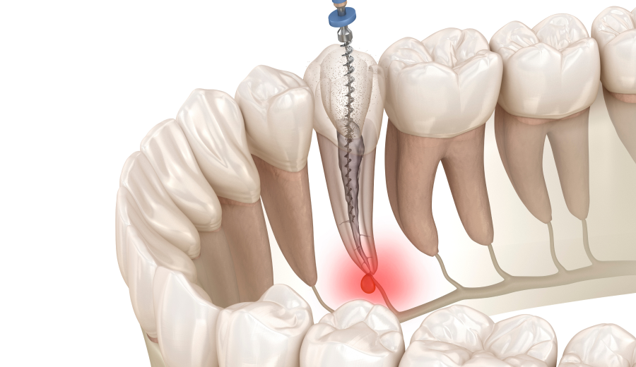Urgences, Pathologies et Cas Complexes en Endodontie : Diagnostic, Traitement et Approches Avancées