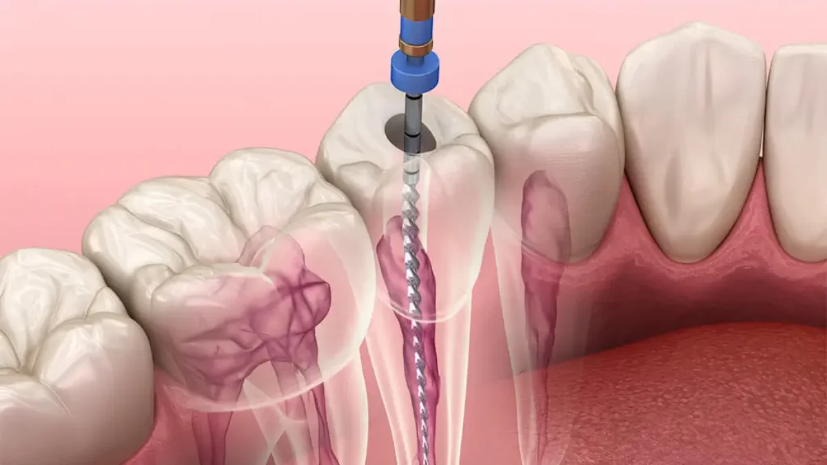 Urgences, Pathologies et Cas Complexes en Endodontie : Diagnostic, Traitement et Approches Avancées