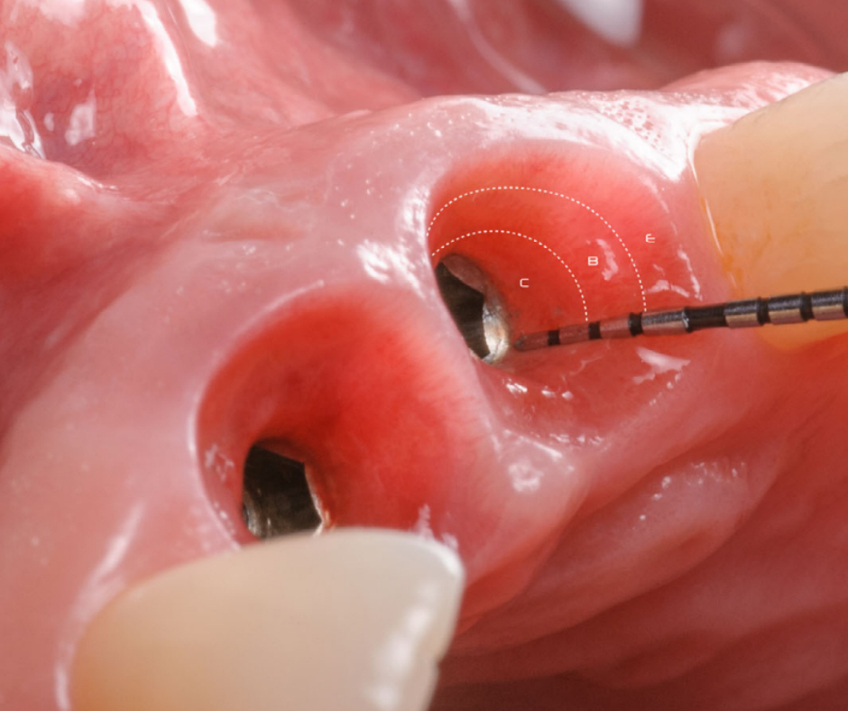 Extraction Implantation Immédiate (Approche Classique et Digitale)