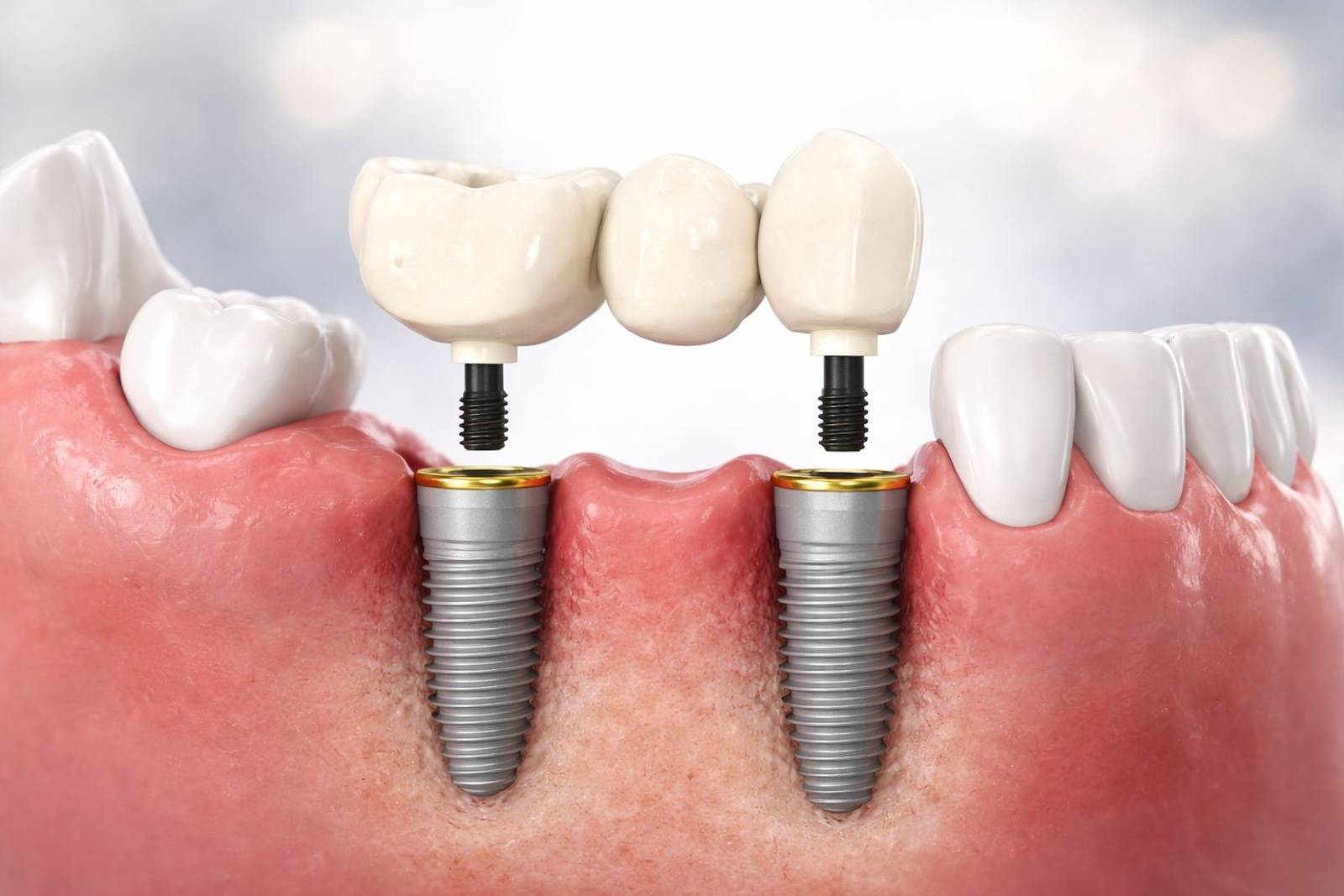 Dentisterie Numérique Avancée : Esthétique Rose & Blanche — image 1