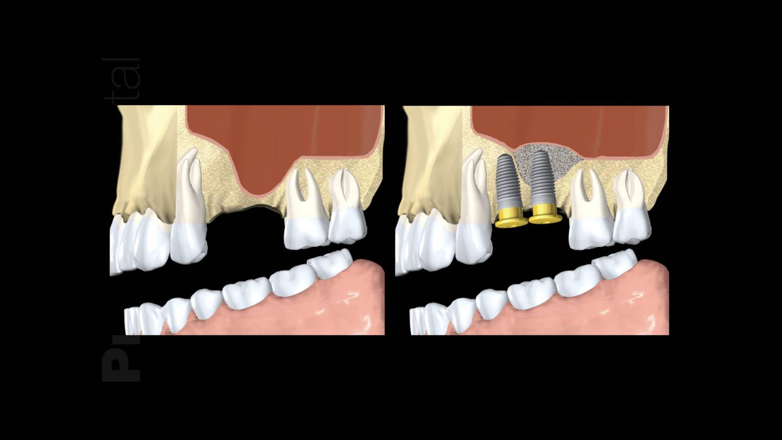 Sinus Lift : protocoles chirurgicaux d’ouverture et de fermeture du sinus maxillaire (Report)